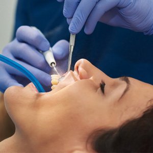 Patient smiling during dental cleaning