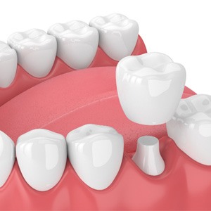 3D render of a dental crown