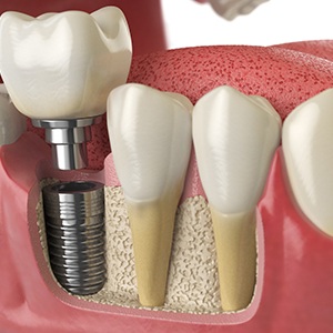 a computer illustration of an implant crown