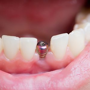 a person with a dental implant in their mouth