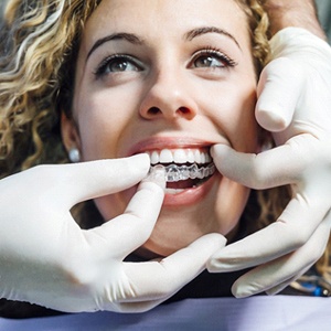 dentist putting Invisalign aligner in patient