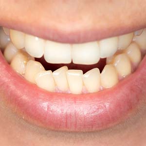 Closeup of patient with crowded teeth in West Mobile