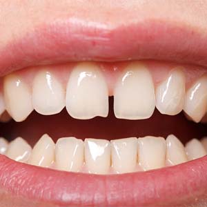 Closeup of patient with gaps between teeth in West Mobile