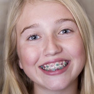 A young patient wearing traditional braces.
