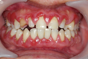 Your West Mobile dentist can help you recognize the signs of periodontal disease.