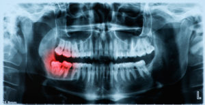 X-ray of wisdom tooth bottom right