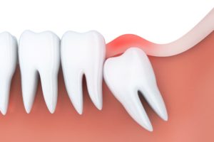 Model of wisdom tooth pain