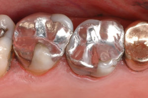 metal fillings